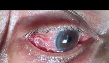 Le dolía mucho un ojo, fue al médico y le sacaron algo horrible 