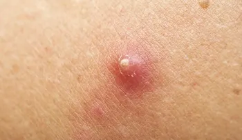 Tratamiento natural para los abscesos