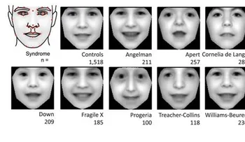 Crean un software capaz de diagnosticar trastornos genéticos por una foto