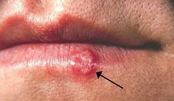 ¡7 técnicas para deshacerte del herpes en un solo día!