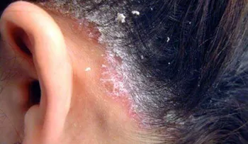 Psoriasis: 8 cosas que no sabías sobre esta enfermedad