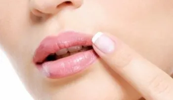 Remedios para evitar el herpes labial
