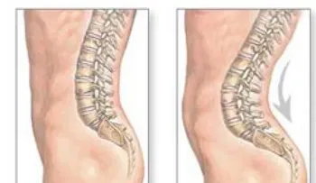  ¿Cuáles son las causas de la hiperlordosis?. Otros síntomas relacionados incluyen: