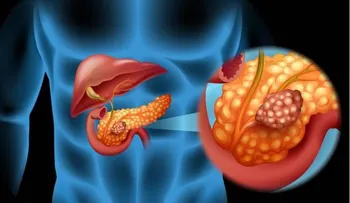 Presentan en México medicamento que ayuda en la lucha contra cáncer de páncreas 
