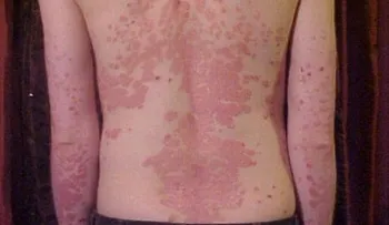 Psoriasis: Una enfermedad muy grave; imágenes de personas afectadas 