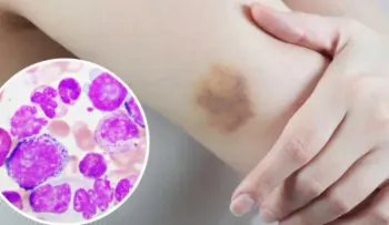 Evolución de la leucemia ya está escrita desde el inicio de la enfermedad