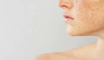 Mascarilla contra el pañoâ?¦ ¡Luce un rostro libre de manchas!