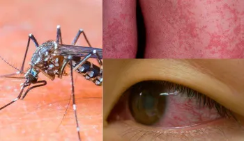 11.700 contagiados del virus zika en Colombia
