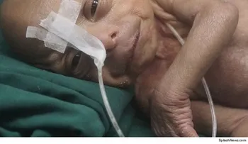 Nace un "bebé anciano" en Bangladesh, que rememora a Benjamín Button en vida real