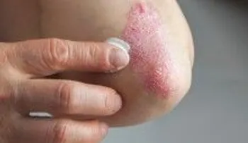 Increíble arma secreta para eliminar la psoriasis !!! 