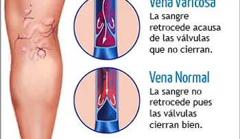 Usé este remedio y las várices empezaron a borrarse el mismo día