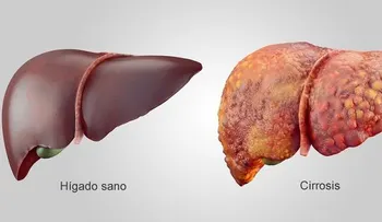 9 remedios caseros para la cirrosis hepática