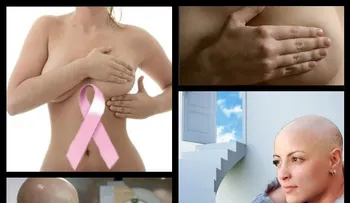 Medicina y quimioterapia aportan beneficios contra el cáncer de mama