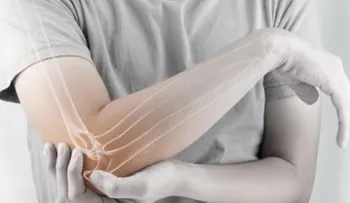 Osteoporosis, la silenciosa enfermedad de los huesos