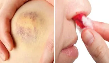 Señales de un cáncer en la sangre (Leucemia), que no debes ignorar 