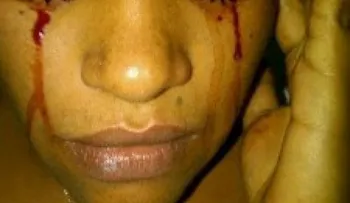  Rara enfermedad provoca que joven brote sangre por sus ojos
