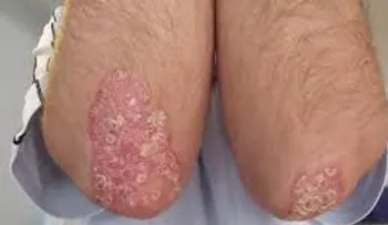 La psoriasis afecta la calidad de vida de quienes la padecen