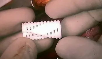 Tubo traqueal impreso en 3D salva a 3 niños 