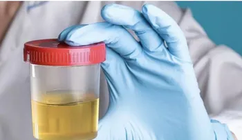 Simple prueba de orina detecta cáncer de próstata