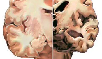 Científicos diseñan cultivo celular reproduce síntomas del alzhéimer 