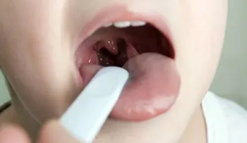 En 3 horas: Cómo quitar la amigdalitis y el dolor de garganta  ¡Sí, Funciona!
