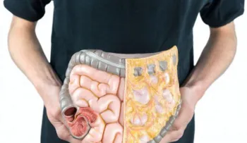 Día Mundial contra el Cáncer de Colon: Cómo prevenirlo