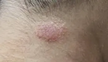 Los mejores remedios para hongos en la piel; bicarbonato con agua tibia, jengibre y vinagre 