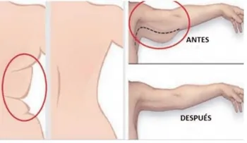 El mejor remedio para la flacidez de los brazos; mujeres y hombres