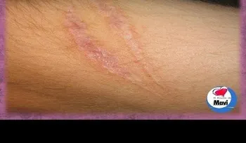 !Atención Mujeres! : La manera fácil de eliminar cicatrices y estrías (VIDEO)
