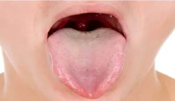 Descubre tu enfermedad según el color de la lengua 