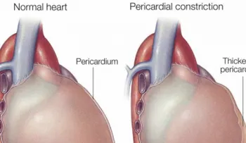 La constricción pericárdica puede afectar considerablemente a los riñones