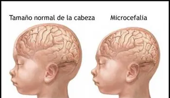 Nace bebé con anomalías congénitas, incluso microcefalia