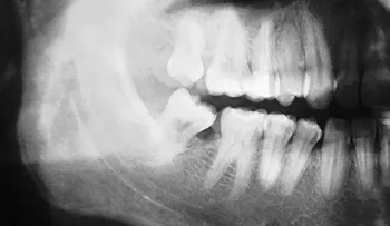 Crean una mandíbula con impresora 3D y la implantan a un niño de 10 años, en China