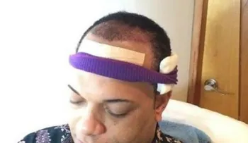 Jary Ramírez se somete a trasplante de pelo