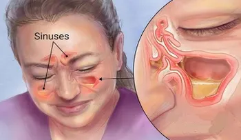 Elimina la infección de la sinus en pocos segundos con este método simple y común de la casa