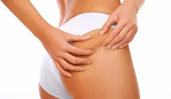 ¿Es posible eliminar la celulitis definitivamente?