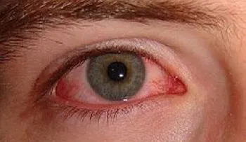 Conjuntivitis se ha convertido en viral y tiene preocupado a la población