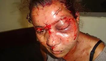 Confirman prisión para hombre golpeó y le sacó un ojo a su expareja en Santo Domingo 