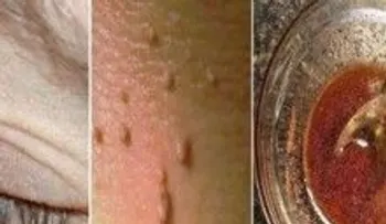 Destruye a tus lunares, verrugas, espinillas y manchas de edad