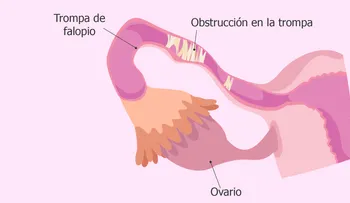  Un estudio ofrece pruebas que el colesterol puede afectar la esterilidad femenina 