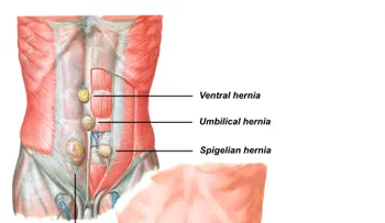 Remedios caseros para hernia umbilical