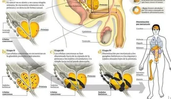 Tratamiento del cáncer de próstata que no desaparece o que regresa después del tratamiento
