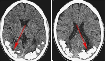 Descubren joven de 24 años, tenía piedras en el cerebro por más de 10 años; sufría de fuertes dolores de cabeza