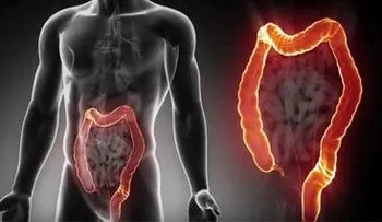Las alteraciones en el ritmo intestinal pueden ser síntomas de cáncer de colon 
