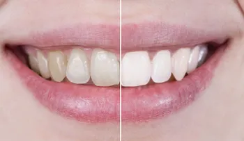 Ocho alimentos que dañan los dientes