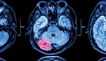 Mujer estaba gestando un bebé en el cerebro