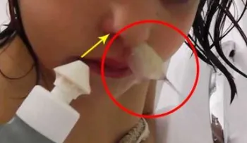 Esta niña sufría de sinusitis y mira lo que sacaron de su nariz! INCREIBLE !