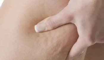 3 infusiones muy efectivas para combatir la celulitis
