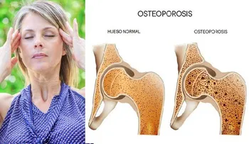 Nutrientes que necesitas para tratar la osteoporosis y el vértigo