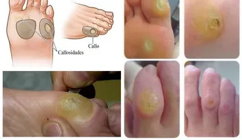 Esta es la forma correcta para que NUNCA vuelva a tener callos